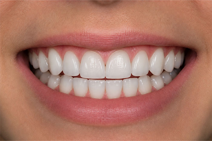 Cosmetic-Composite-Bonding-Path-after