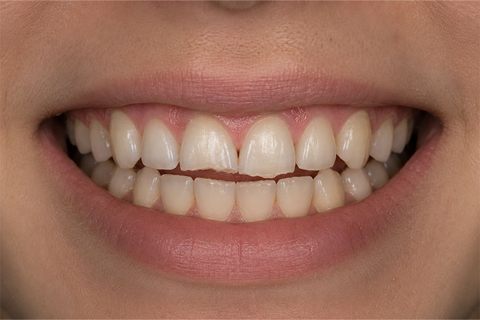 Cosmetic-Composite-Bonding-Path-before