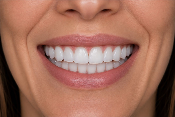 Porcelain-Veneers-Placement-Case-after
