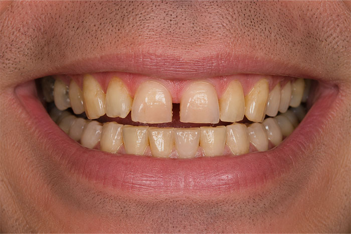 Smile-Makeover-before